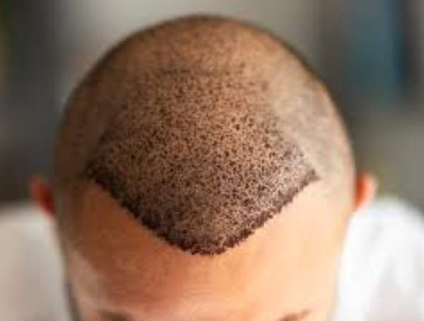 Hair Transplant